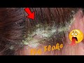 ITCHY DRY SCALP | SCRATCHING DANDRUFF !! Dry Itchy Scalp #580