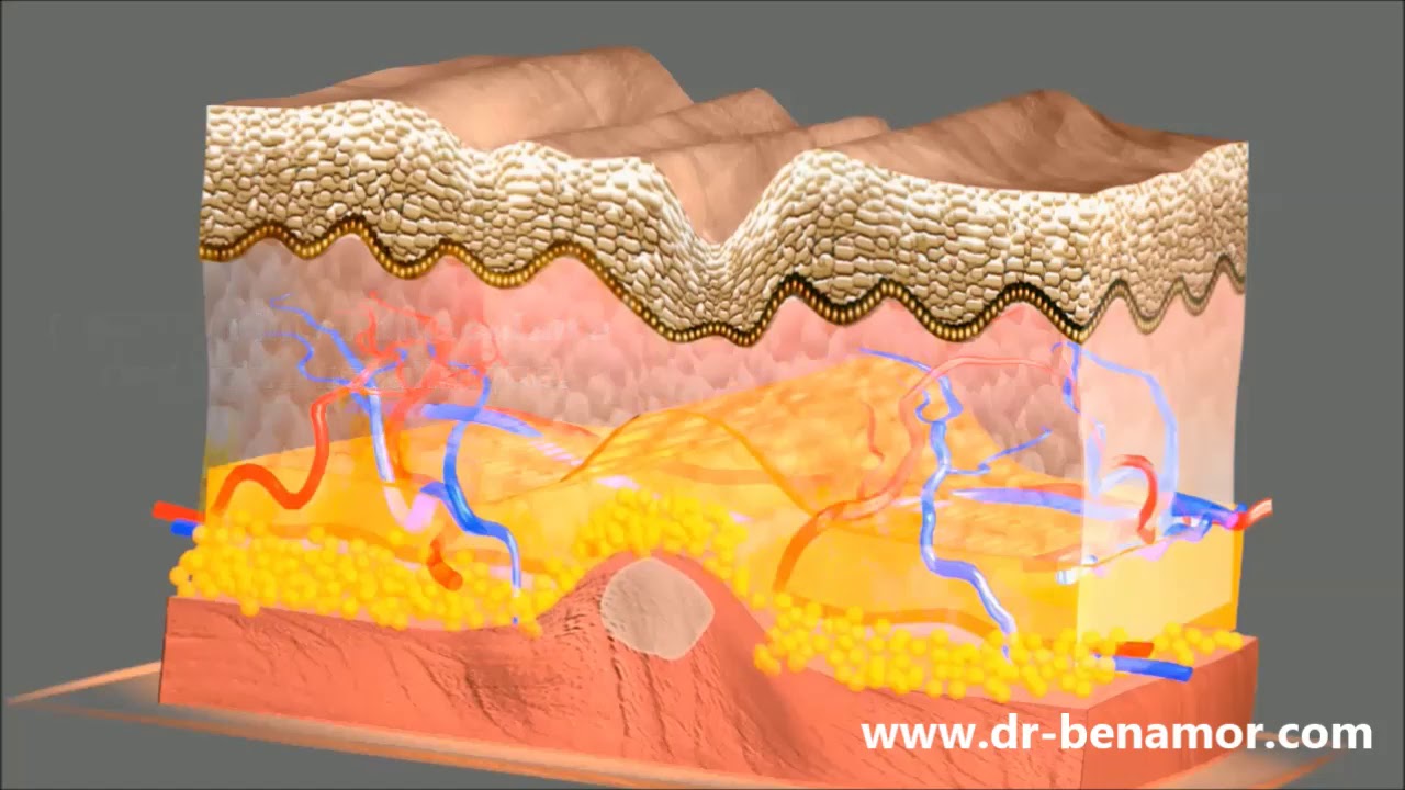 Injection de botox à Paris 9 - Dr Benamor