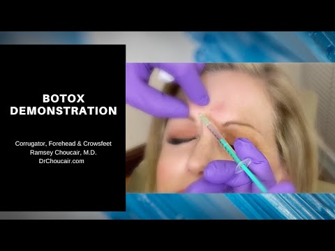 ვიდეო: Overkill ერთად Botox? დენიზ რიჩარდსი შეშინებული მუწუკით შუბლით