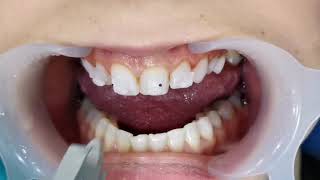 placing on ceramic braces, putting on ceramic braces bonding of clear braces التقويم السيراميكي