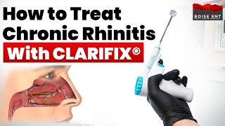 How to Treat Chronic Rhinitis with ClariFix® | Boise ENT