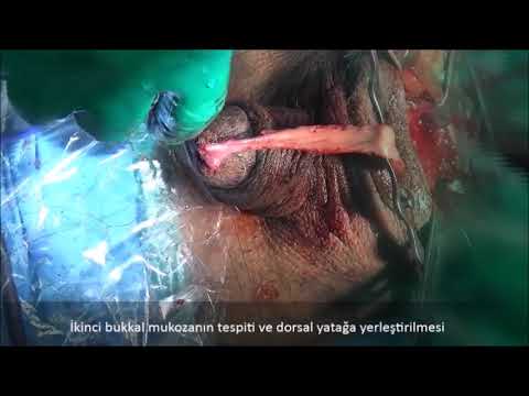 Kulkarni&rsquo;s  urethroplasty in patients with panurethral stricture/Panüretral darlıkta Kulkarni