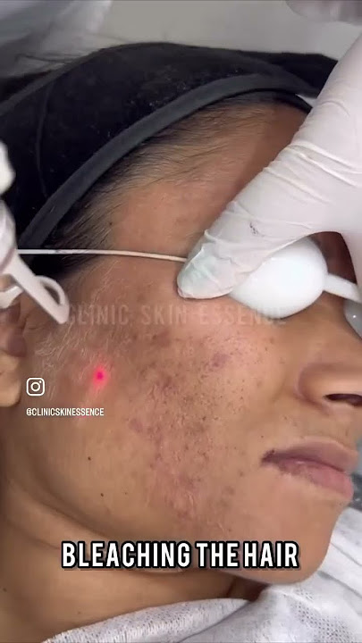 Laser Carbon Q-Switched untuk noda jerawat dan warna kulit tidak merata.
