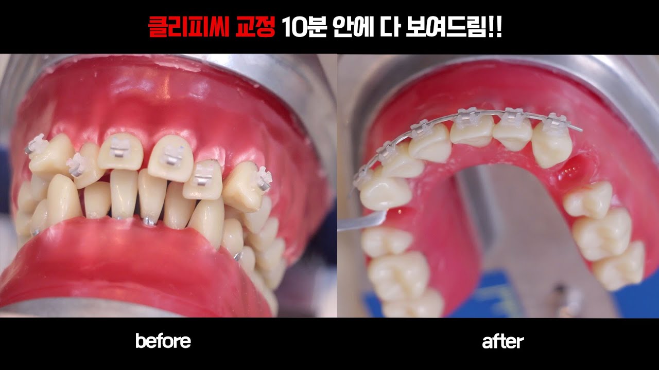 클리피씨 치아교정 3개월의 과정을 10분안에 보여주는 영상