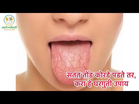 सतत तोंड कोरडे पडते तर करा हे घरगुती उपाय #Dry #mouth