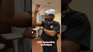 Scarless Arm Lift or Brachioplasty by Dr. Okoro