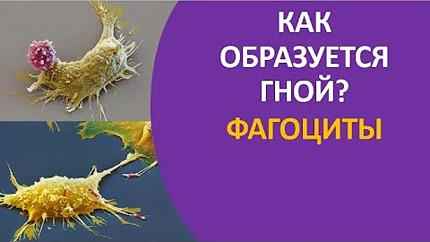 28. Как образуется гной? Фагоциты