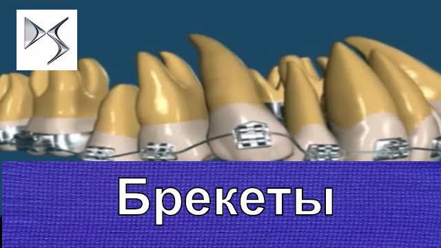Брекеты Как работают брекеты Ортодонтия Стоматология - YouTube