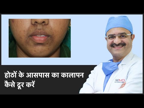 होठों के आसपास का कालापन कैसे दूर करें (How To Remove Dark Spots Around Mouth) | (In HINDI)