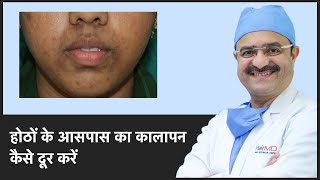 होठों के आसपास का कालापन कैसे दूर करें (How To Remove Dark Spots Around Mouth) | (In HINDI)