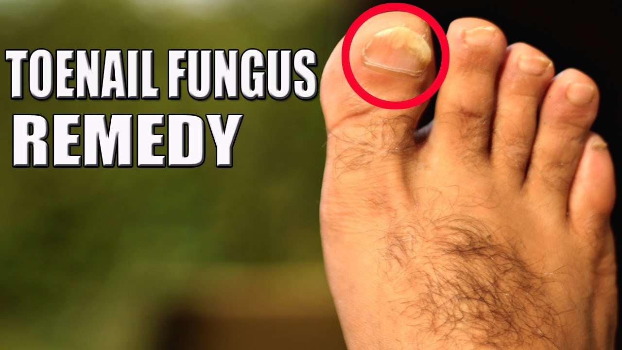 nail fungus soda és ecet kezelése)