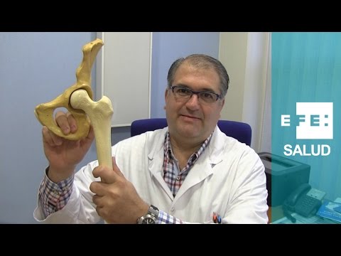 Vídeo: Fractura Del Cuello Femoral En Ancianos