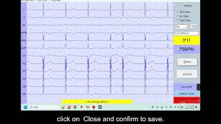 How to save ECG data to the format of XML?