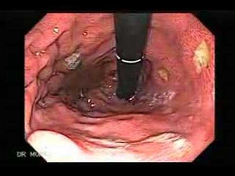 Endoscopia de Múltiples Ulceras del estómago - YouTube
