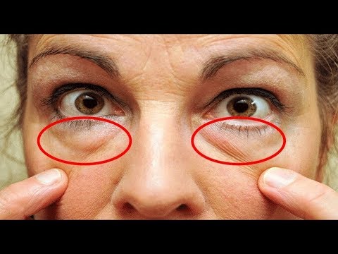 Video: Wie Und Wie Schwellungen Und Augenringe Unter Den Augen Entfernen?