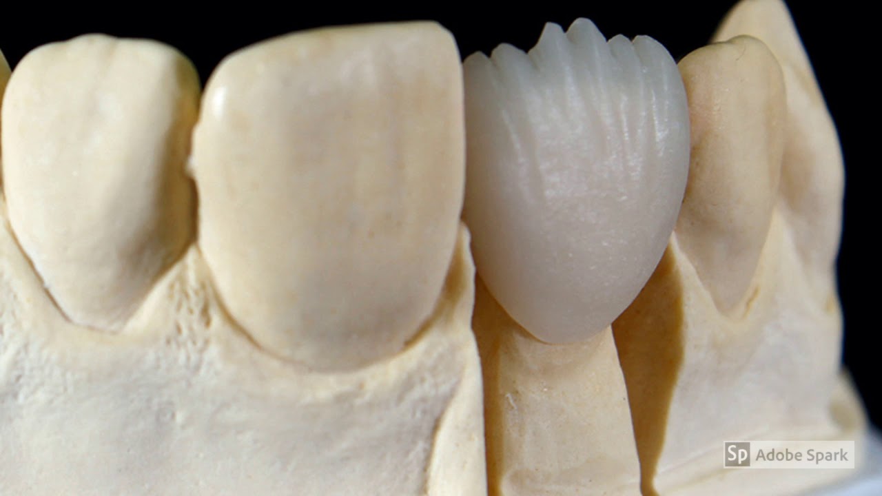 Videolezione prof.Ciccone sulla termopressatura del disilicato di litio