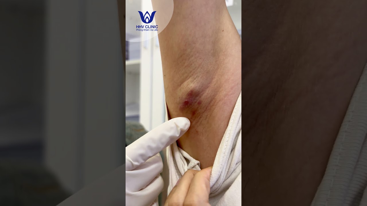 Mụn áp xe sưng viêm to đau nhức ở nách.