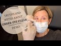 UNDER EYE FILLERS Before & After | Restylane Results, Truths & MYTHS | Dominique Sachse