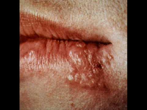 Cold Sore Information and Treatment