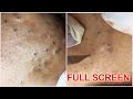 5 years old  blackheads removal  best pimple poppings
