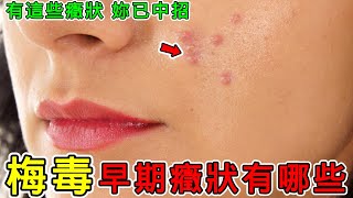 Health What Are the Early Symptoms of Syphilis How Should We Prevent It