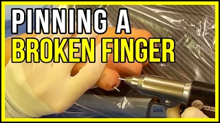 Fixing A Finger Fracture With Pins