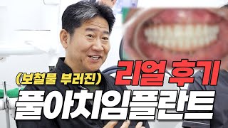 내돈내산, 풀아치 임플란트 과정🦷 마지막 진료날!  풀아치 단점까지 싹 다 말씀해드릴게요!!