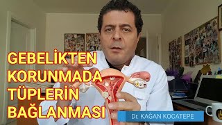 Hamilelikten korunma ve aile planlama için Fallop tüplerinin (kordon) bağlanması nasıl bir işlemdir?