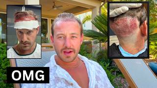 I got a hair transplant - how it looks the day after (Casey Zander)