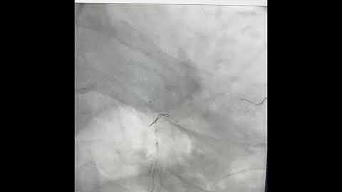 Step by step IVUS guided puncture