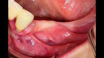 Horizontal ridge augmentation using titanium mesh and rhBMP-2