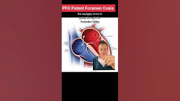 PFO What Is A Patient Foramen Ovale How Do You Fix PFO 
