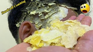 Dandruff Combing Big Flakes #596