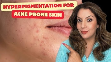 Effective Hyperpigmentation Treatment for Acne Prone Skin | Clear Your Skin Fast | Nipun Kapur