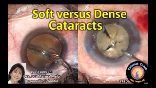 soft versus dense cataracts -- pre-chopper (soft) and ultra-chopper (dense)