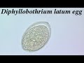 Diphyllobothriasis
