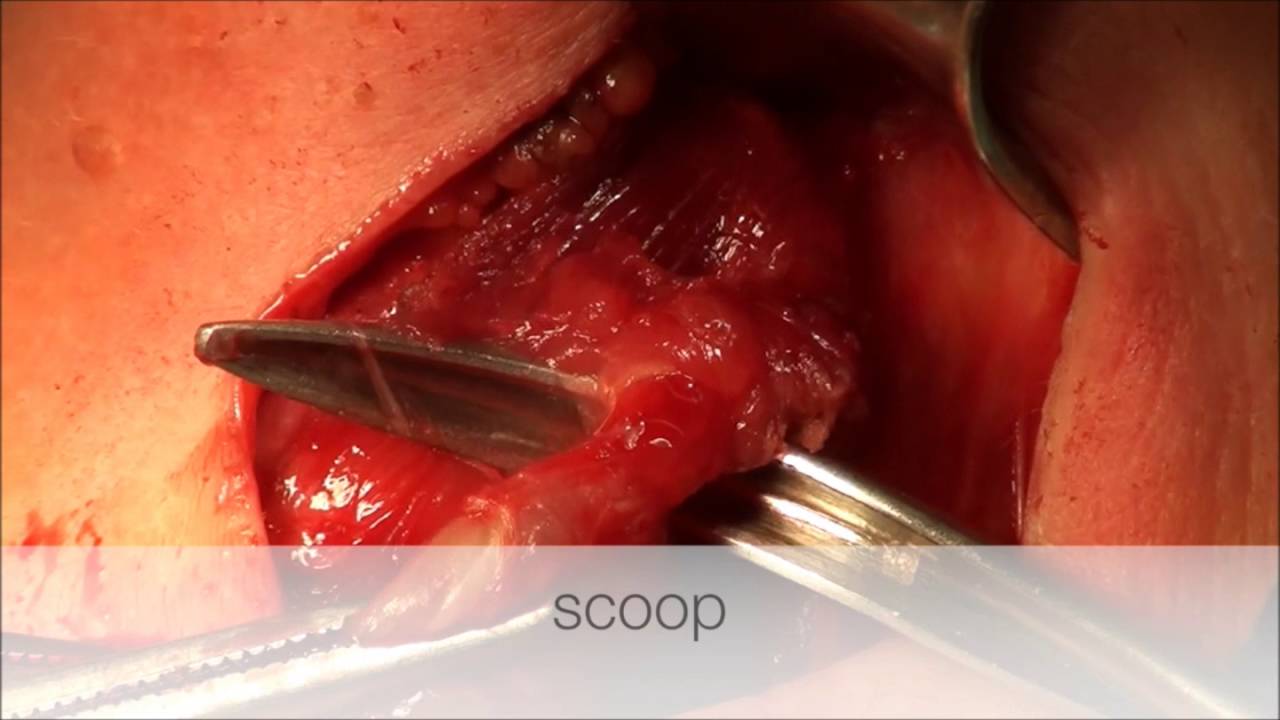 subtotal thyroidectomy