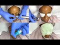 Hydrodermabrasion Facial with Oxygen Infusion Treatment