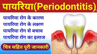 पायरिया (periodontitis) | periodontitis- Causes, Symptoms, Diagnosis, Treatment | payriya rog | bio