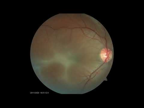 Vitrectomy for deeply rooted Macular Pucker with External Limiting Membrane Peel Hudson Nakamura, MD