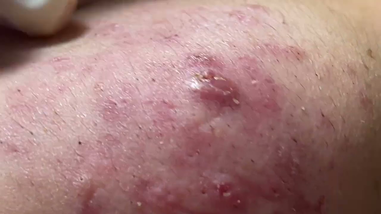 OMG !!! Blackhead - P2