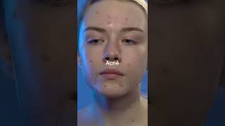 Cómo el estrés arruina tu rostro en semanas #salud #dermatología