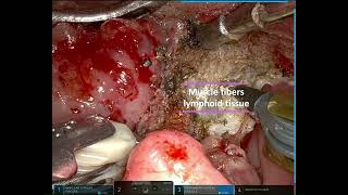 BASE OF THE TONGUE GLOSSECTOMY BY TRANS ORAL ROBOTIC SURGERY (TORS)