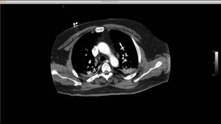 STR Cardiothoracic Web Case Conference 12/15/2016