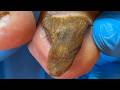 Triangular Onychomycosis, Perfect For Removing Bad Nails!【Xue Yidao】