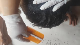 Remove Thousand Of Lice From Head, Louse In Hair Removal Part 01