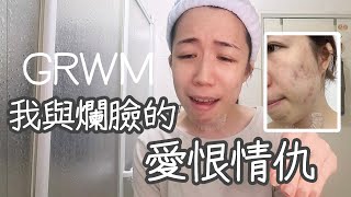 粉刺自己掉出來了!?🫣爛臉日記之痘痘快去死一死🖕🏻好後悔沒有早點做這件事…| Yuna悠那