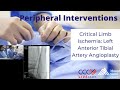 Critical Limb Ischemia: Left Anterior Tibial Artery Angioplasty - March 28, 2018