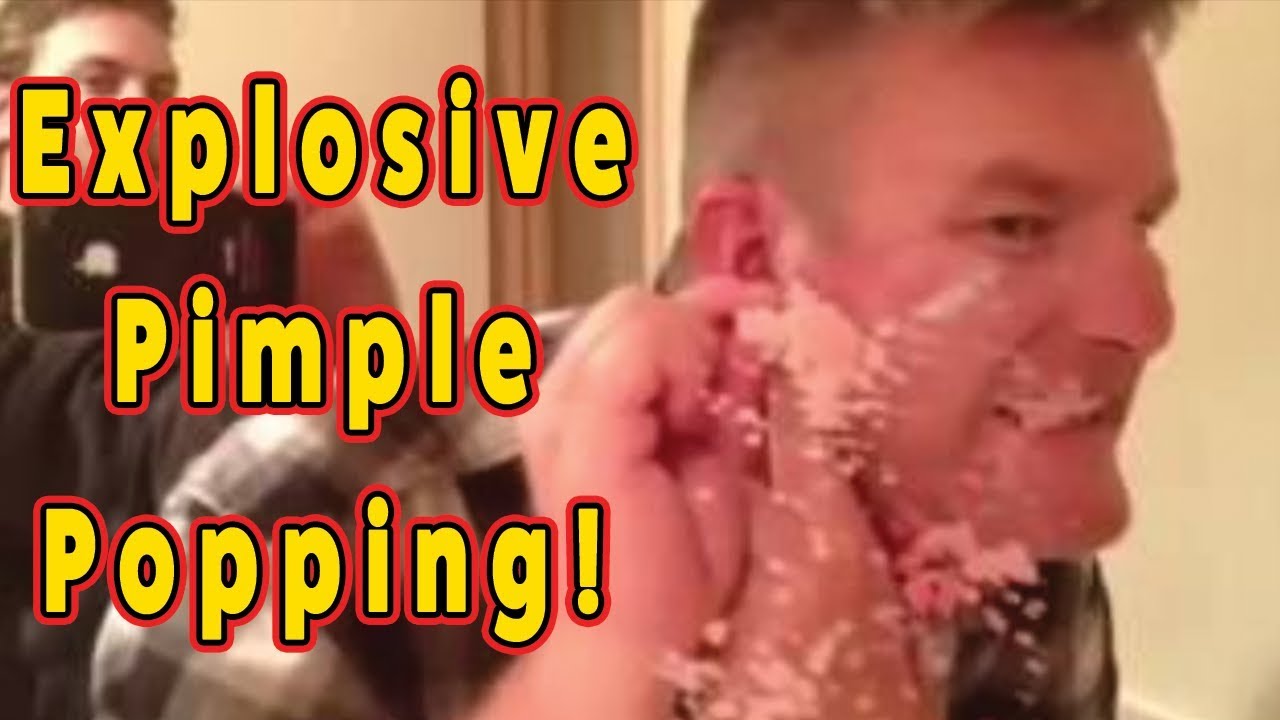 DISGUSTING Pimple and Cyst Popping VERY Explosive! YouTube