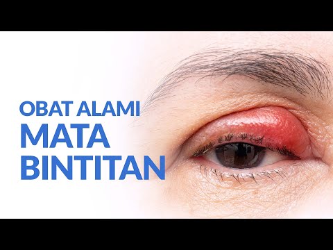 Video: Apakah es dapat membantu mengatasi bintitan?